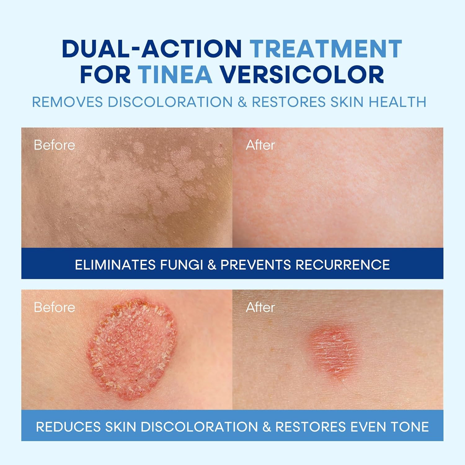 Hermon Tinea Versicolor Treatment Cream & Soap: Clinically Proven Cream for Athl