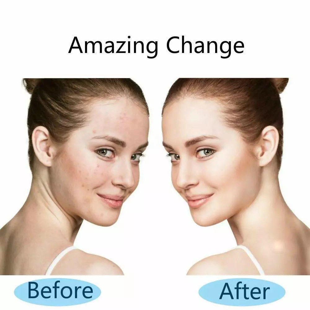 0.5MM-2.0MM Hair Regrowth Micro-Needling Roller Stimulates Hair Growth Painless
