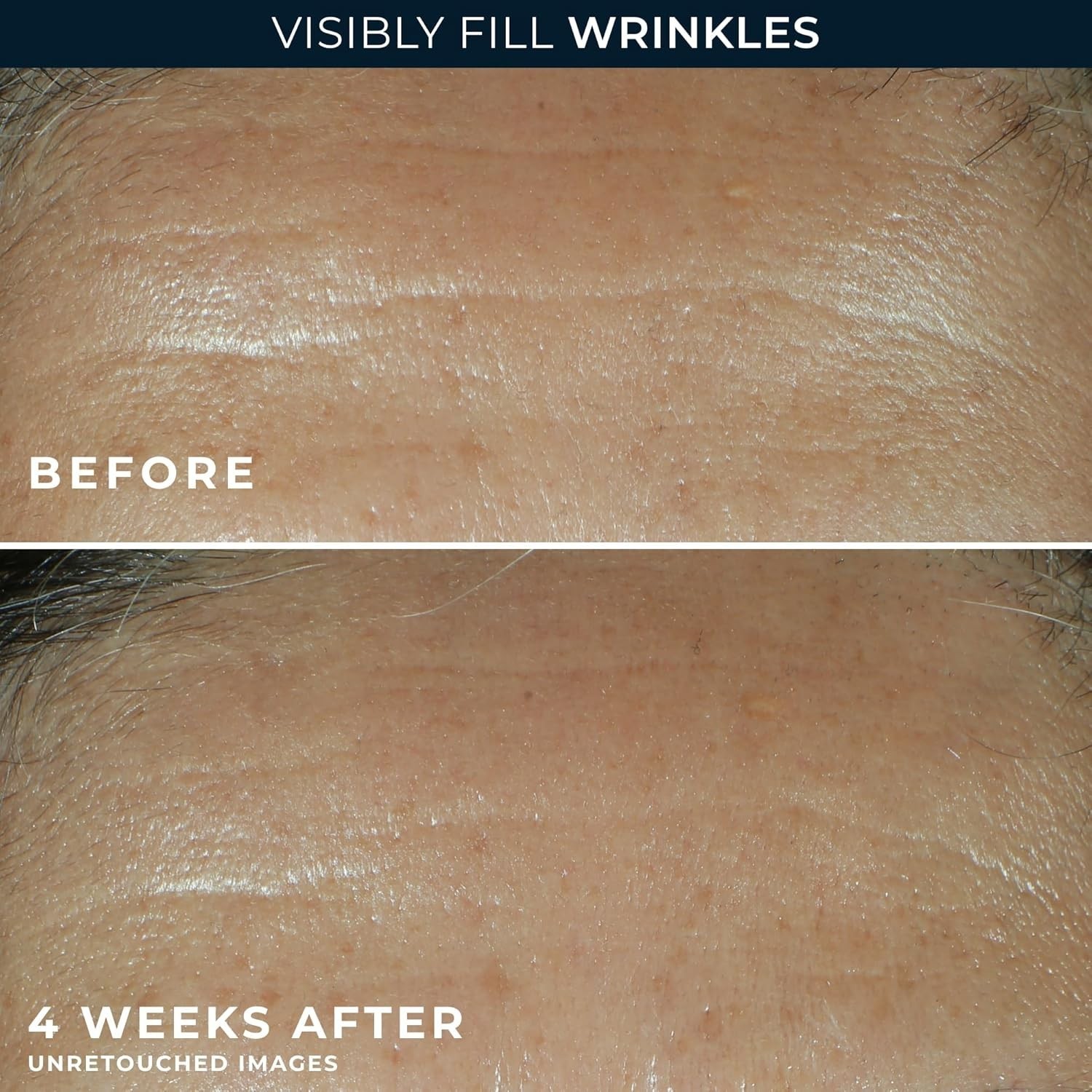 Retinol Correxion Wrinkle Filler for Deep Wrinkles with Hyaluronic Acid & Retino