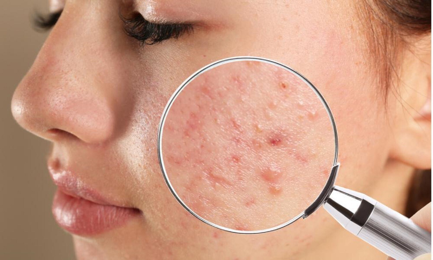ACNE BACTERIA KILLER – BACTERIA ACNE SOLUTION – Made in USA – 100% Natural