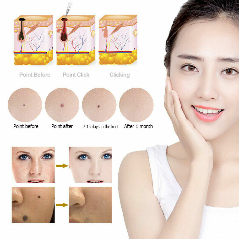 Laser Plasma Pen Tattoo Mole Freckle Spot Mole Removal Skin Tag Wart Remover Pen