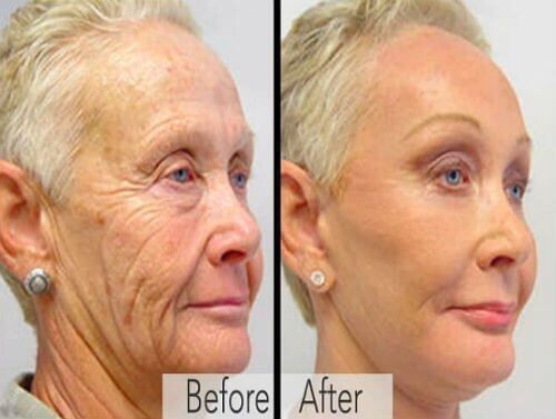 8oz – Retinol, Niacinamide, Vitamin C, Hyaluronic Acid, AntiAging Wrinkle SERUM