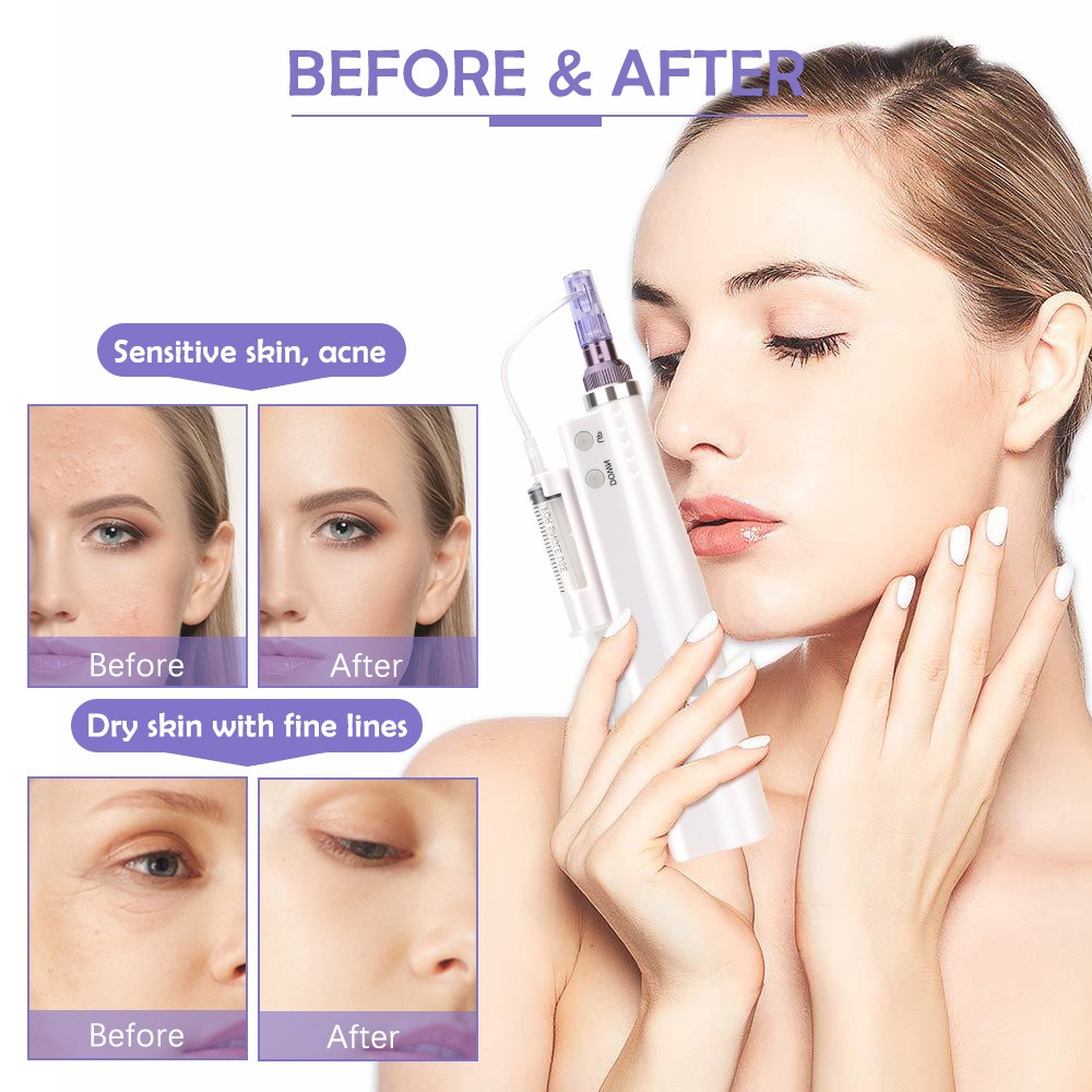 Therapy Water Micro-Pen Skin Acne Mark Remove with 2Pcs Nano Pin Cartridges Tips
