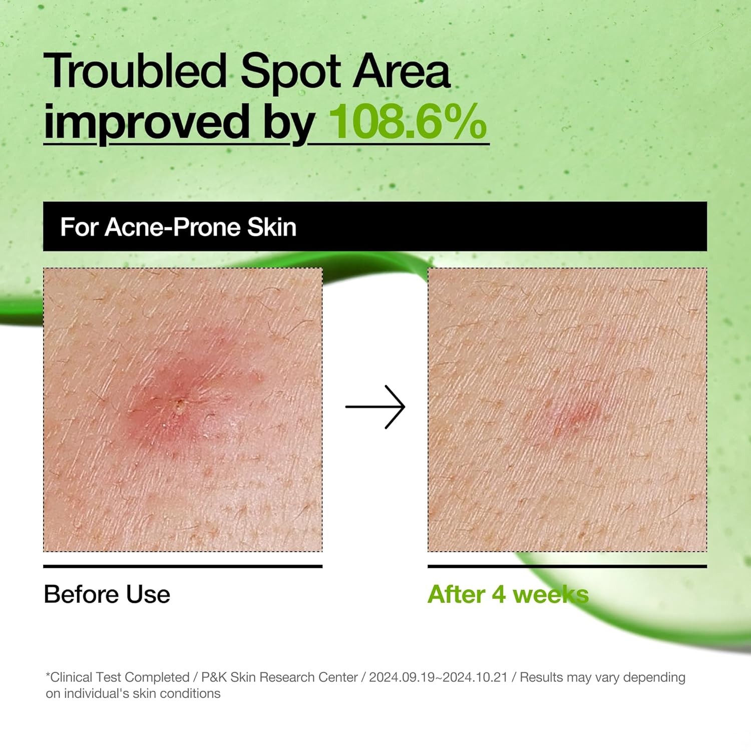 Anua Azelaic Acid 10 Hyaluron Redness Soothing Serum, Facial Serum for Blemish-P
