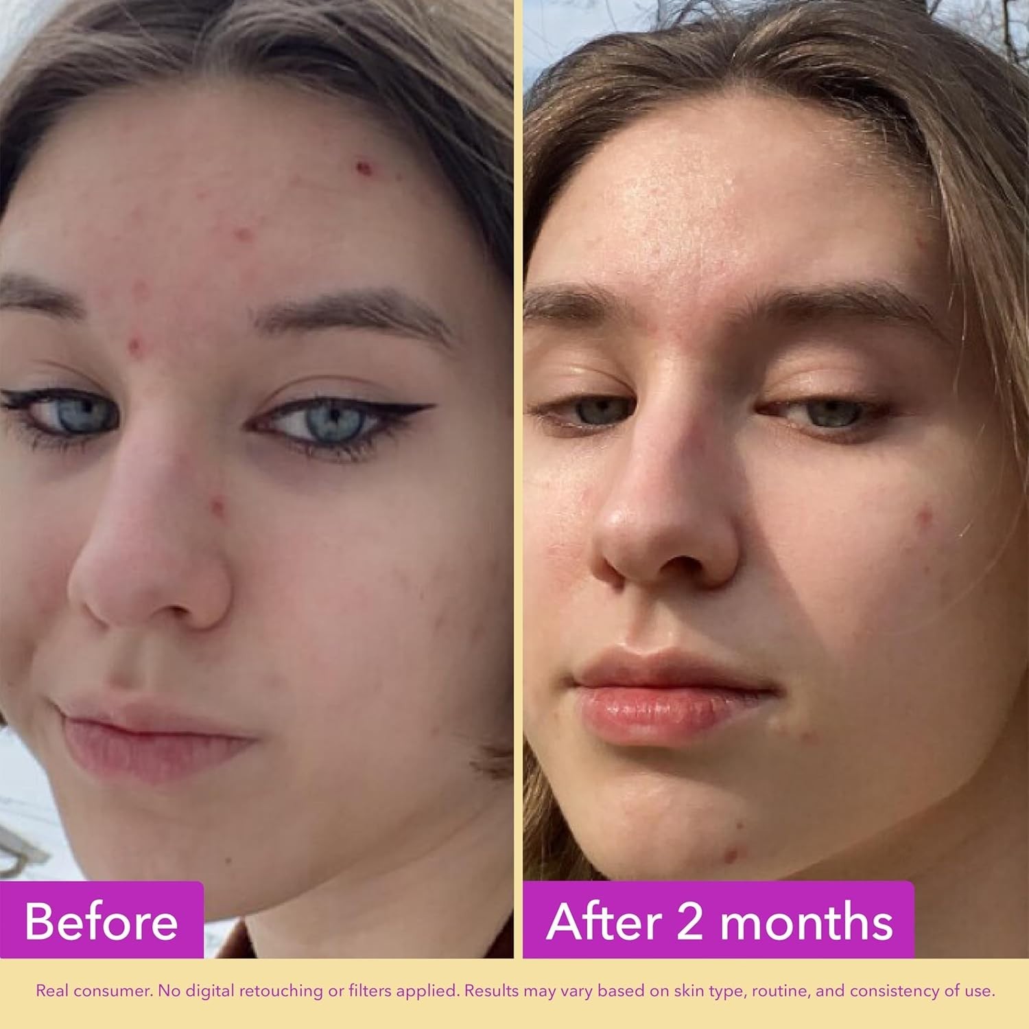 Good Molecules Niacinamide Serum – 10% Niacinamide to Target Blemishes