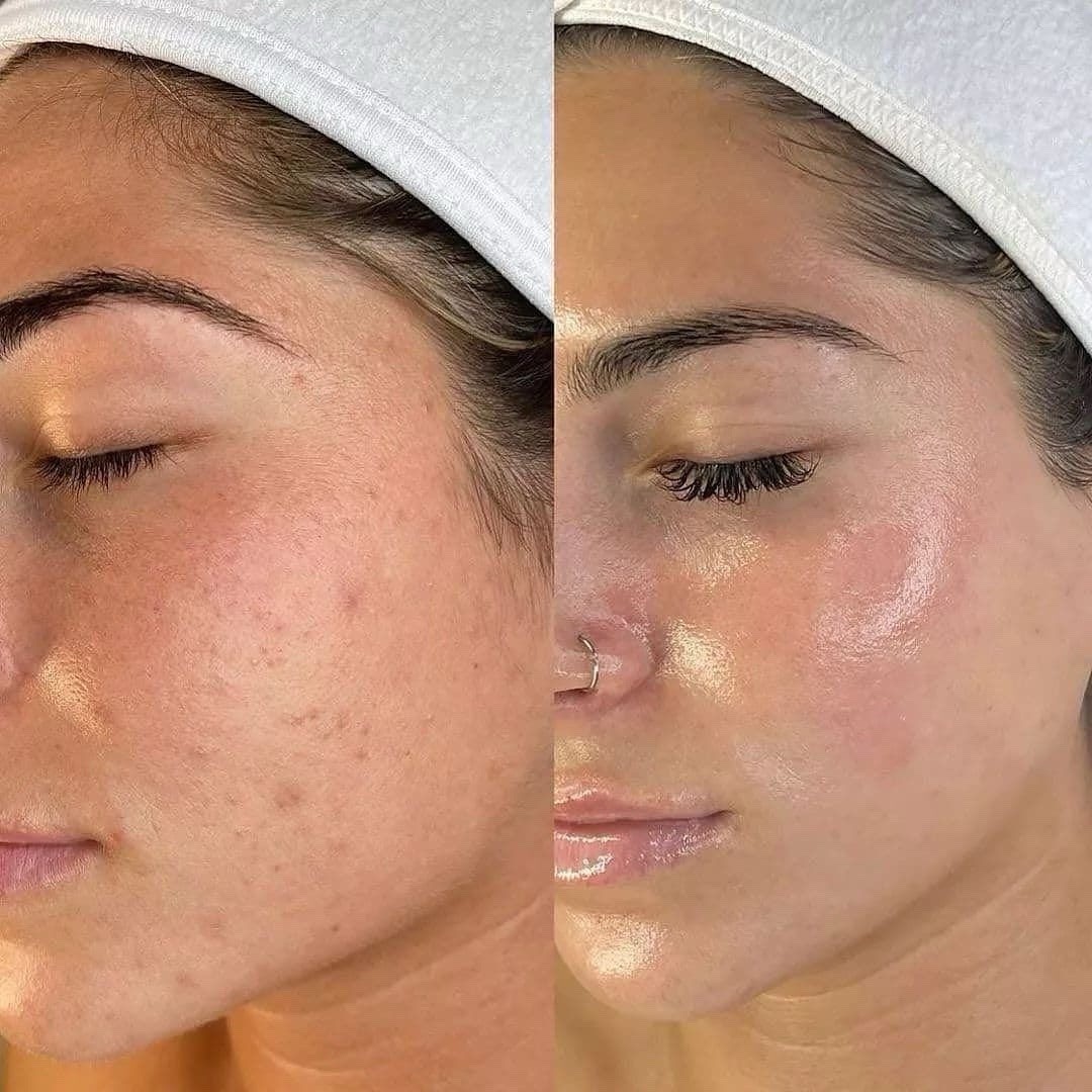 Rejuvenating Spicule Bio-needling Kit | 100% Pure Silica Spicules