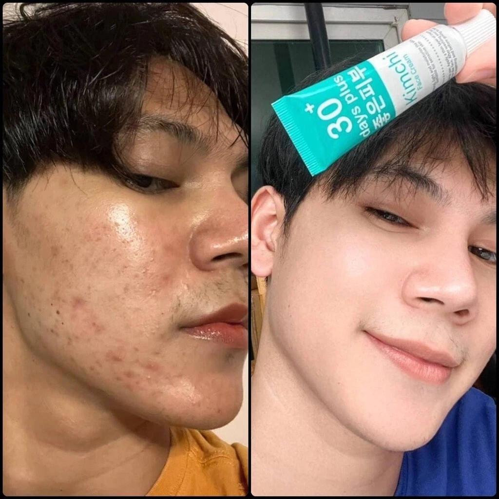 8X Kimchi Face Cream 30Days Plus Moisturizer Skin Radiance Remove Blemishes 15ml