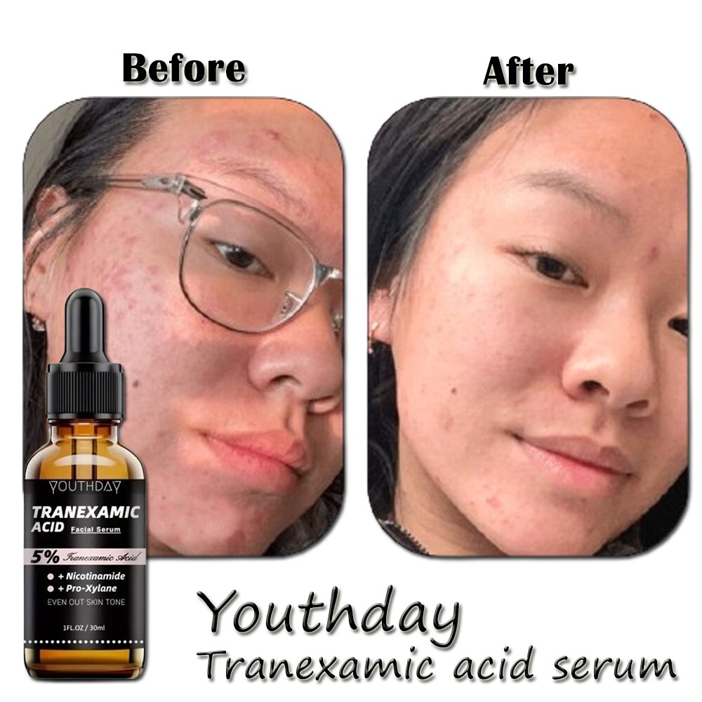 5% Tranexamic Acid Serum for Face – 1 fl oz / 30ml – Skin Brightening Serum