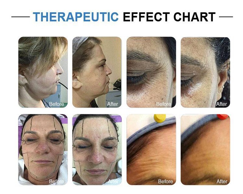 Skin Tightening Anti-aging Beauty Machine for Facial & Neck Skin Wrinkle Removal