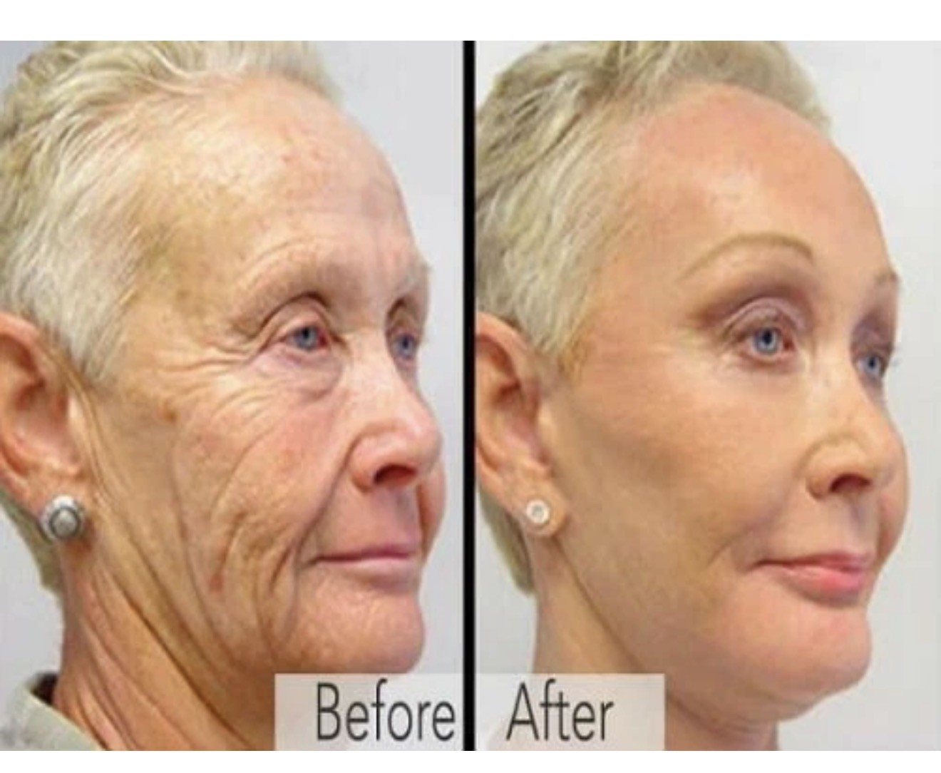ANTI-AGING WRINKLE SERUM 8oz – Retinol, Niacinamide, Vitamin C, Hyaluronic Acid