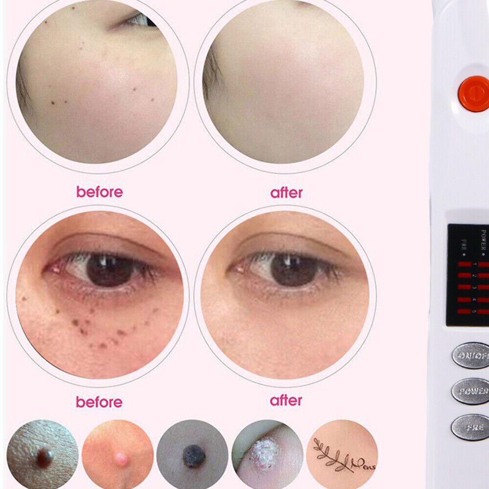 Beauty Monster Plasma Pen Fibroblast Eyes Skin Lifting Freckle Mole Scar Removal