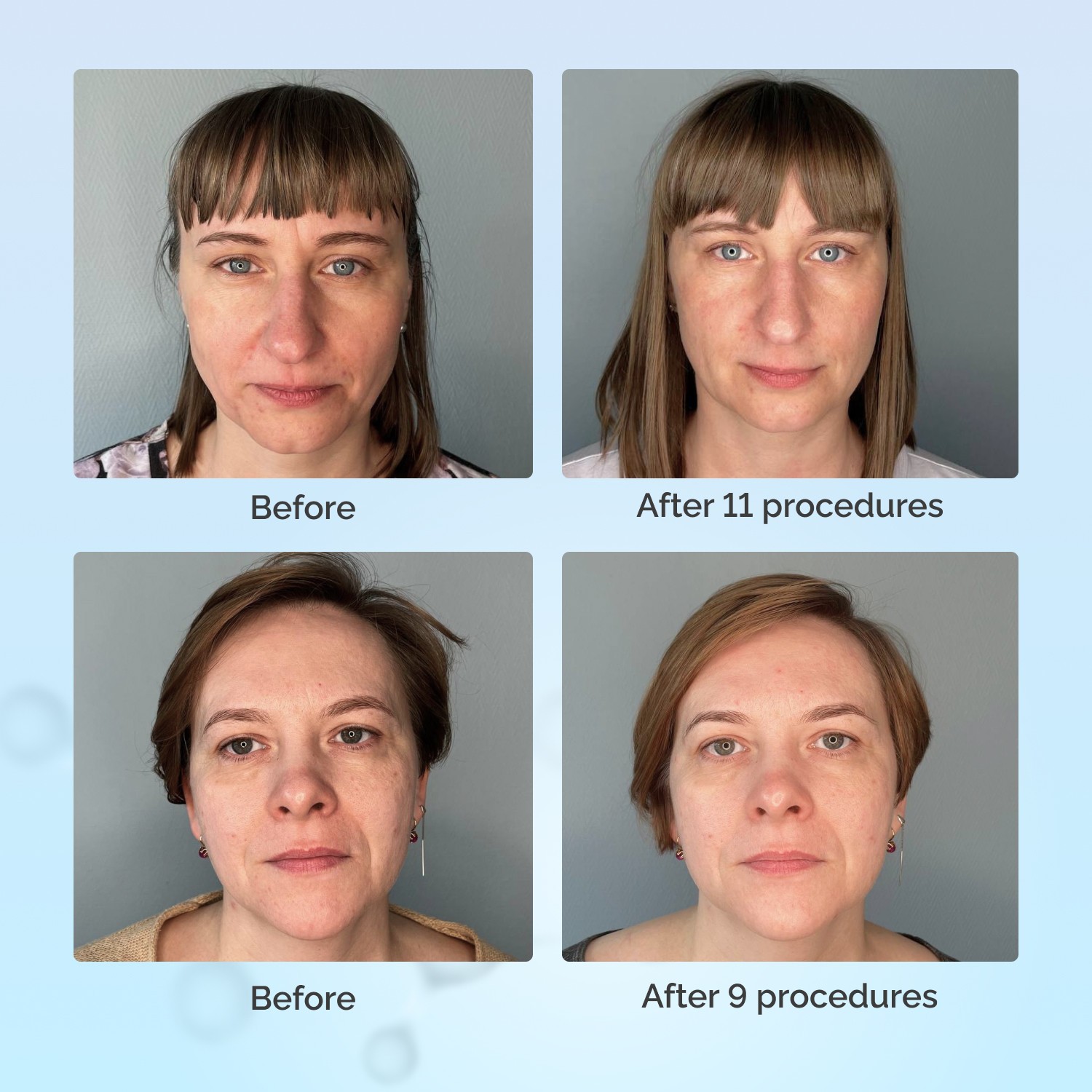 GESS FaceActive Original BMS NAZAROV method Anti-Aging Anti Wrinkle Face Massage