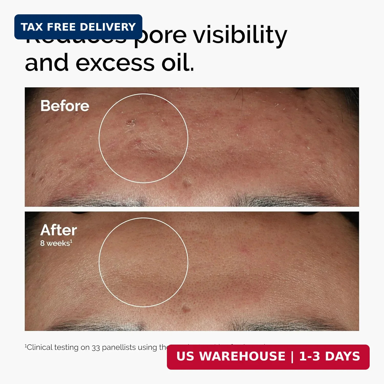The Ordinary Niacinamide 10% + Zinc 1%, Smoothing Serum for Blemish-Prone Skin