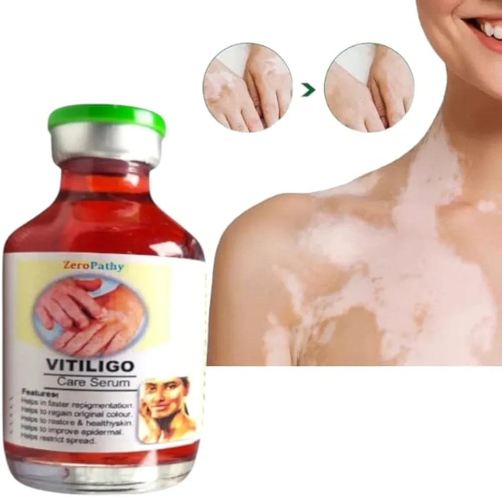 Vitiligo Gel 35ml – Clears White Spots, Evens Tone & Fades Scars