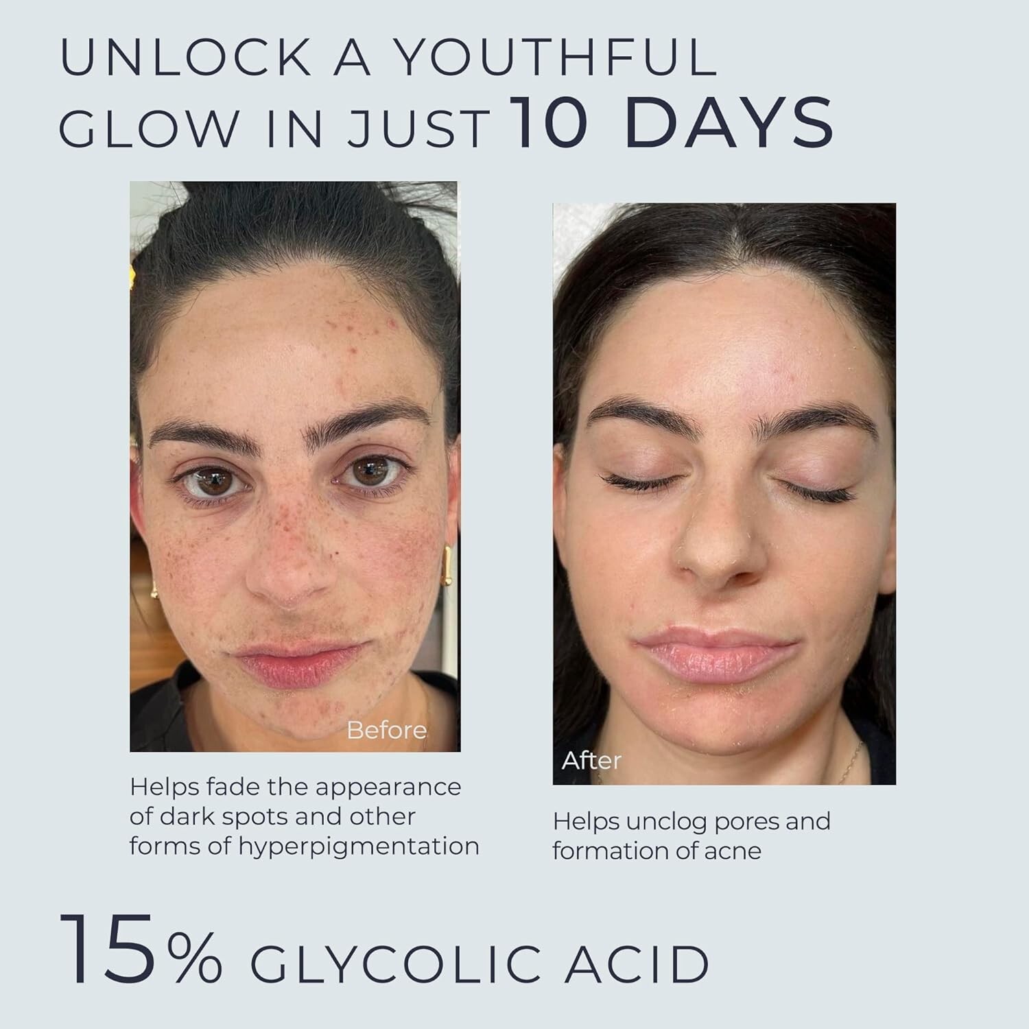 Glycolic Acid Serum for Face 15% Strength – Extra Large Size (2Oz) New Formula