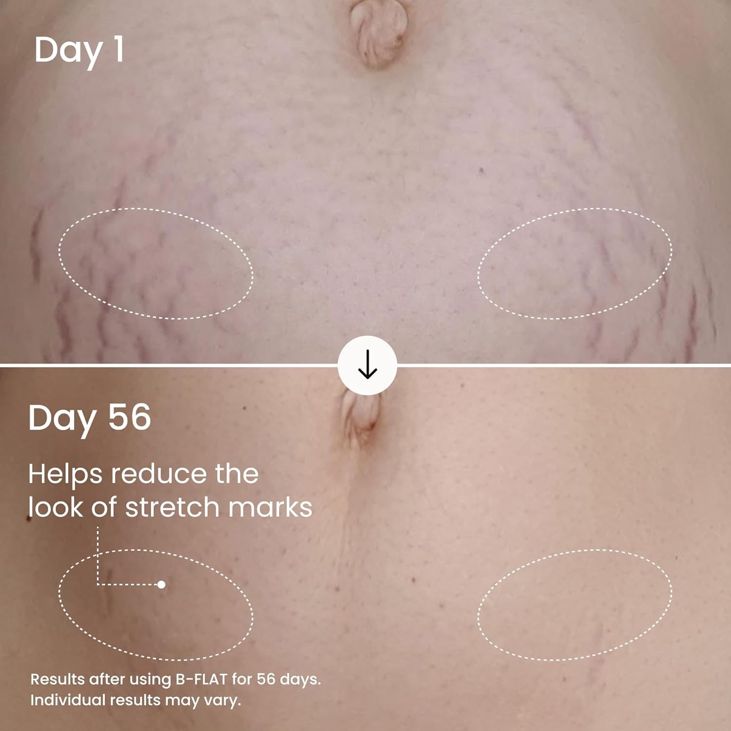 Clinically Proven Stretch Mark Cream for Women – 3.38 Fl Oz