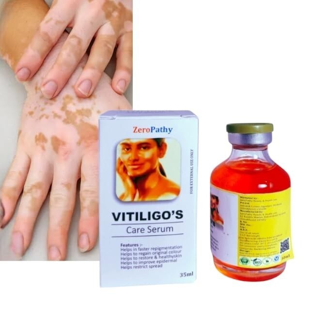 Vitiligo Gel 35ml – Clears White Spots, Evens Tone & Fades Scars