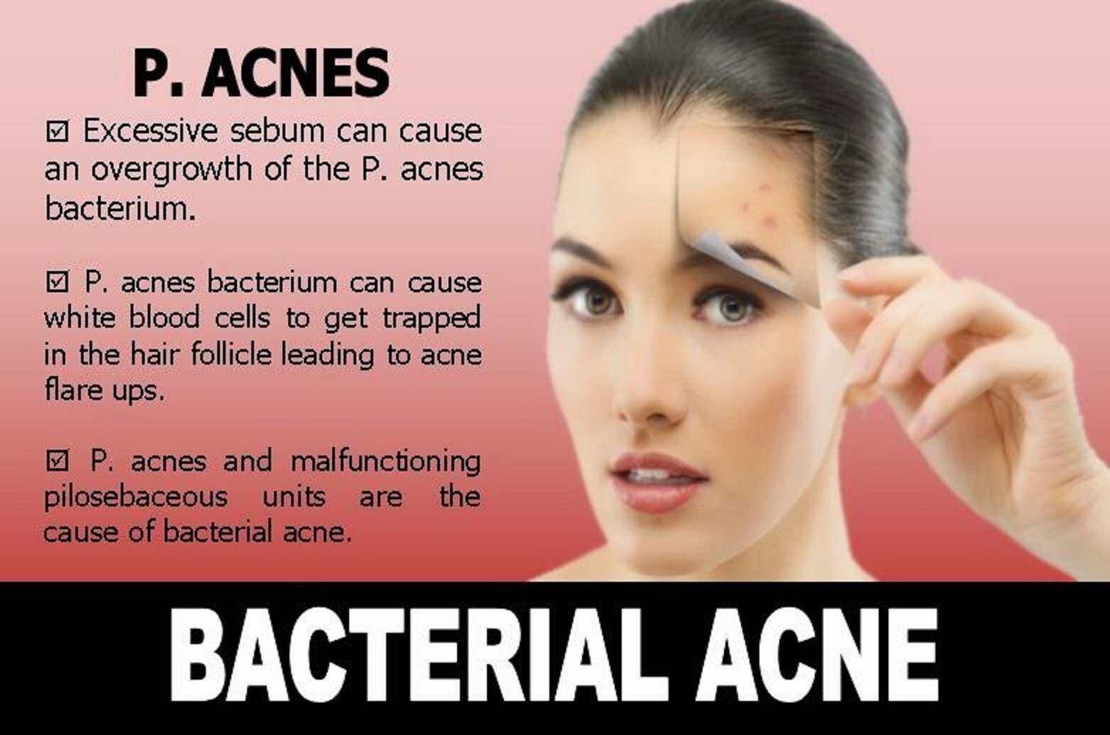 ACNE BACTERIA KILLER – BACTERIA ACNE SOLUTION – Made in USA – 100% Natural