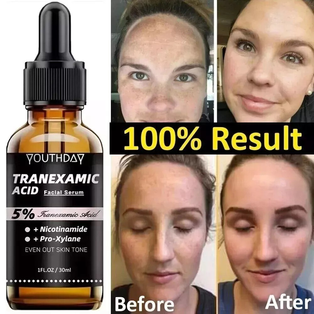 5% Tranexamic Acid Serum With Niacinamide, Kojic Acid, Arbutin, Reduce Dark Spot