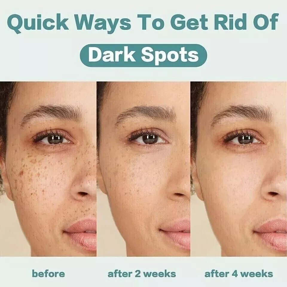 5% Tranexamic Acid Serum With Niacinamide, Kojic Acid, Arbutin, Reduce Dark Spot