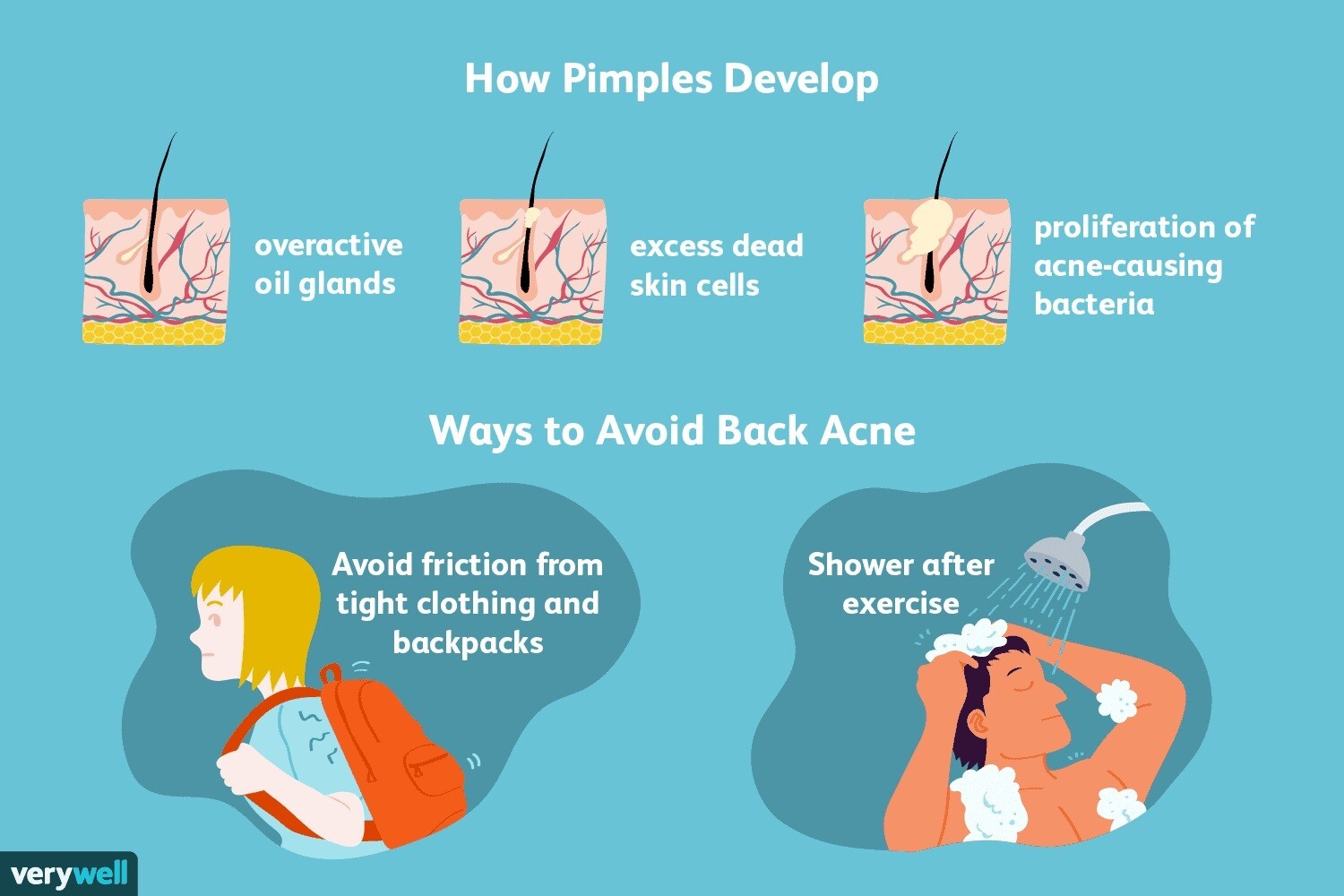 ACNE BACTERIA KILLER – BACTERIA ACNE SOLUTION – Made in USA – 100% Natural