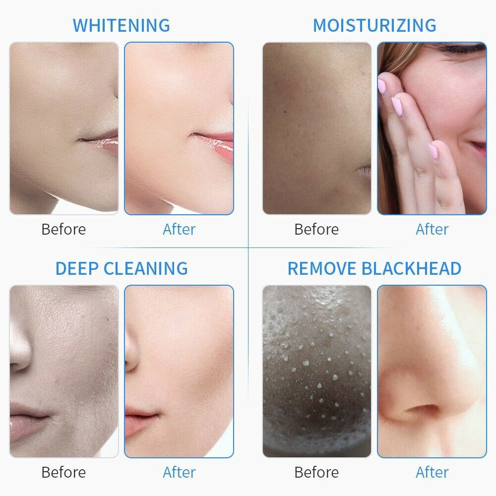 6 in1 Hydro Dermabrasion Machine for Facial Skin Exfoliating Shrink Pore Salon