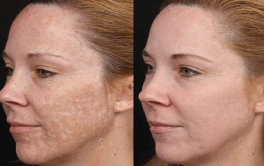 LasmaX-Skin® Anti Aging DARK SPOT CORRECTOR for Face, Body Age Spot Remover