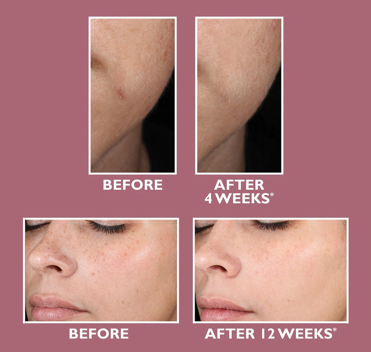 Niacinamide 10% +Zink 1% +Hyaluronic Acid | Acne/Blemish/Oil Control Serum/Cream