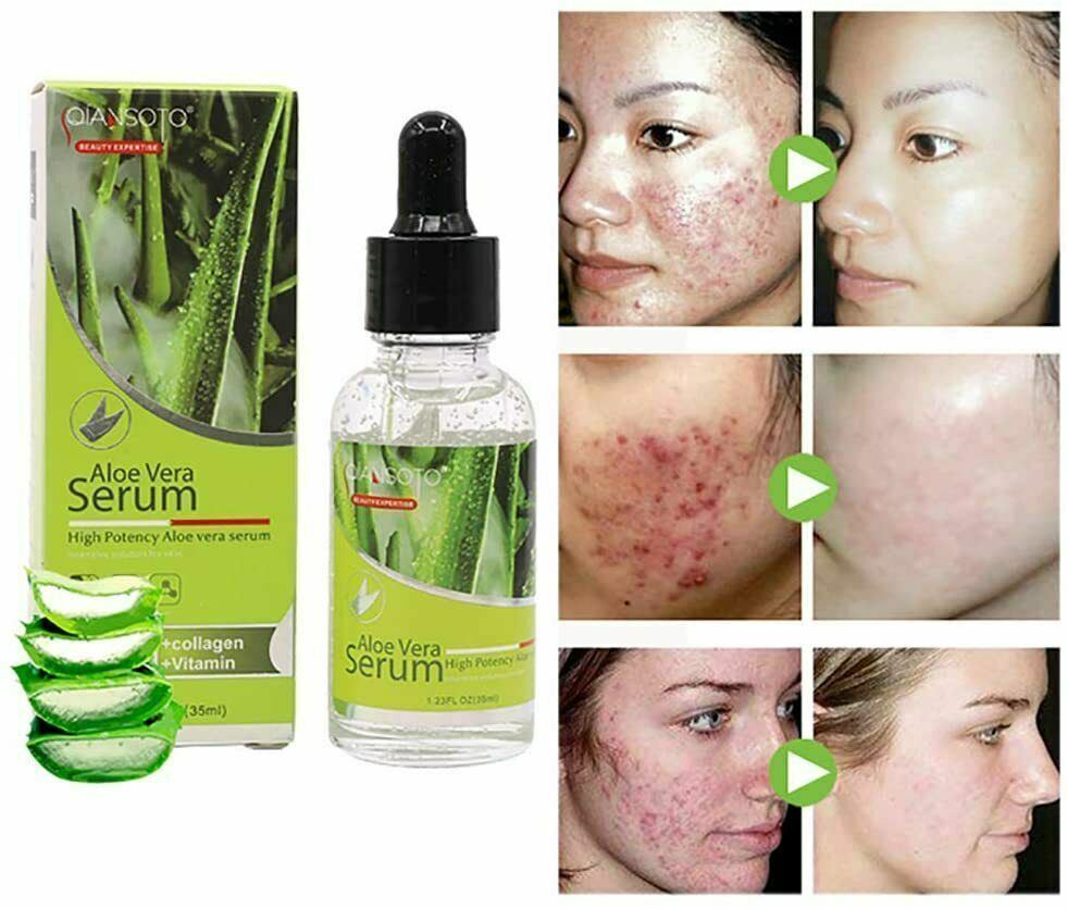 Natural Acne Skin Repair Soothing Liquid High Potency Aloe Vera Facial Serum