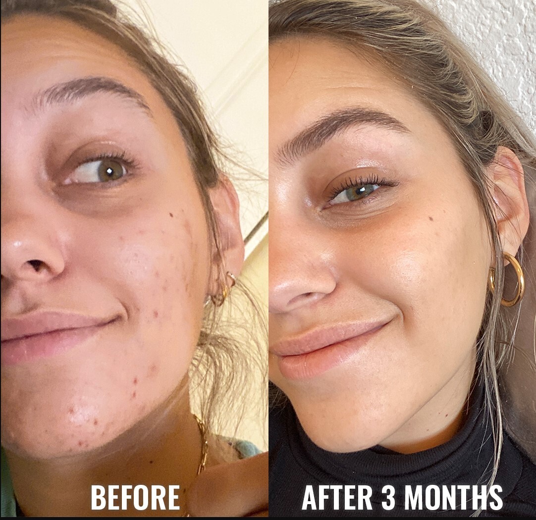Niacinamide 10% +Zink 1% +Hyaluronic Acid | Acne/Blemish/Oil Control Serum/Cream