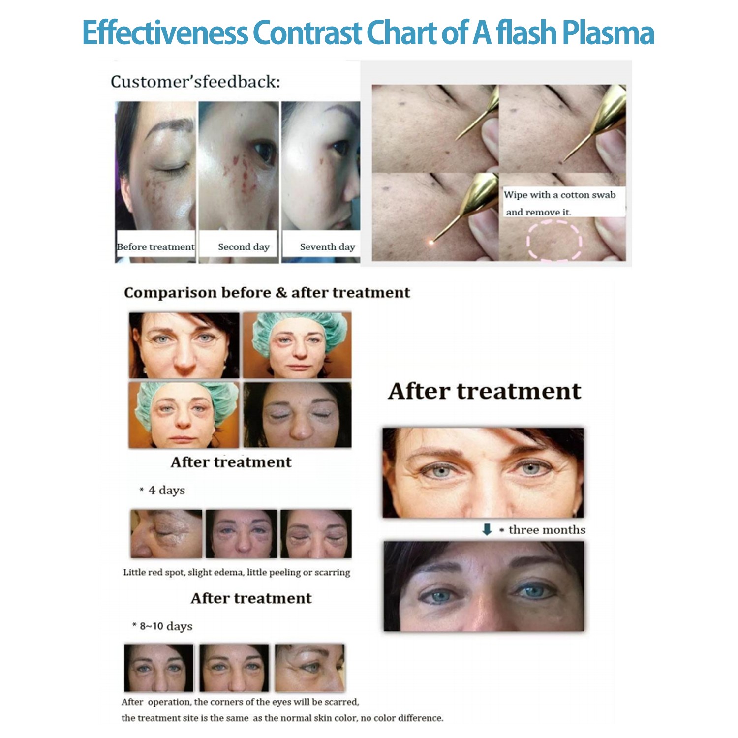 2in1 Plasma Ozone Eyelid Lift Acne Scar Removal Skin Rejuvenation Beauty Machine