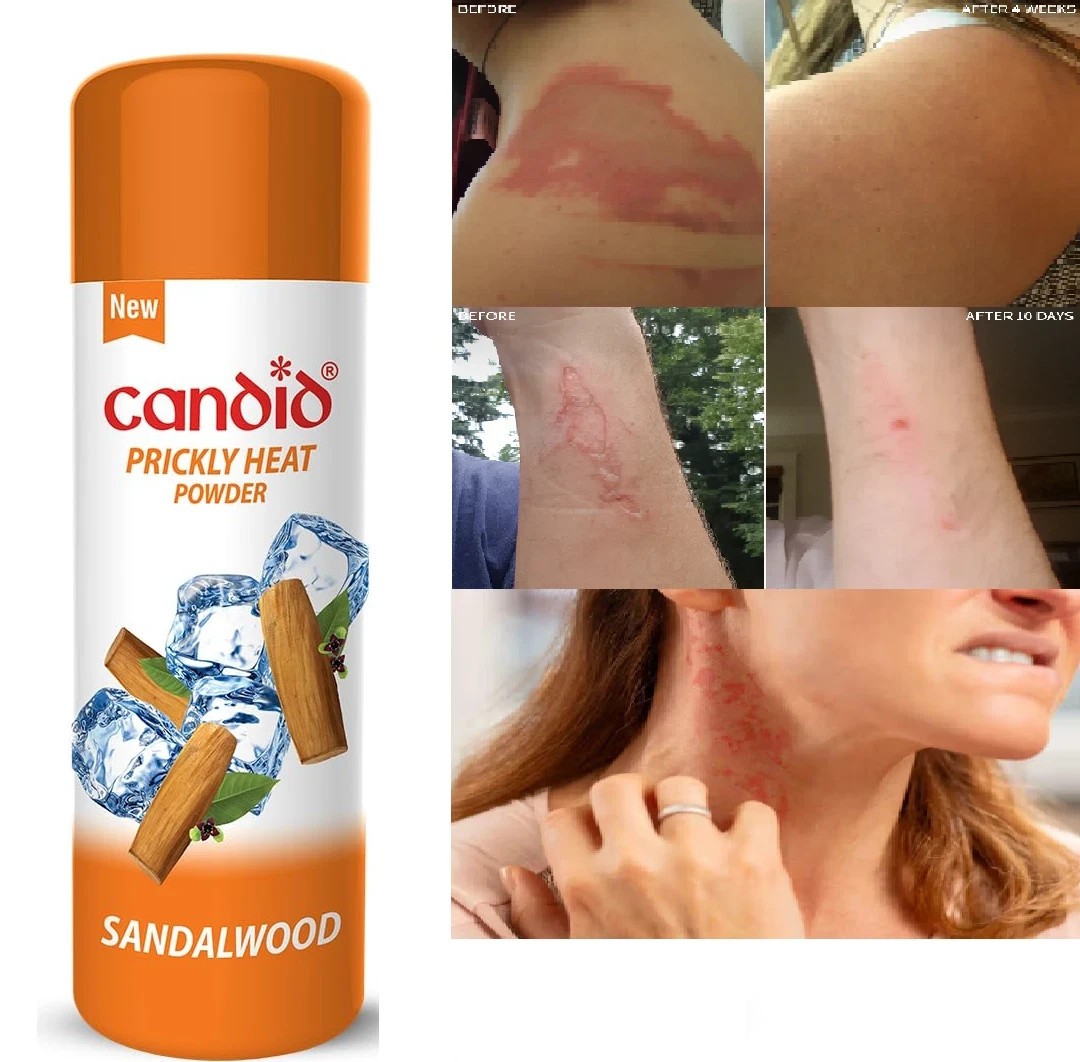2 X Candid Prickly Heat Powder Cooling Effect On itching With Sandalwood 120gm
