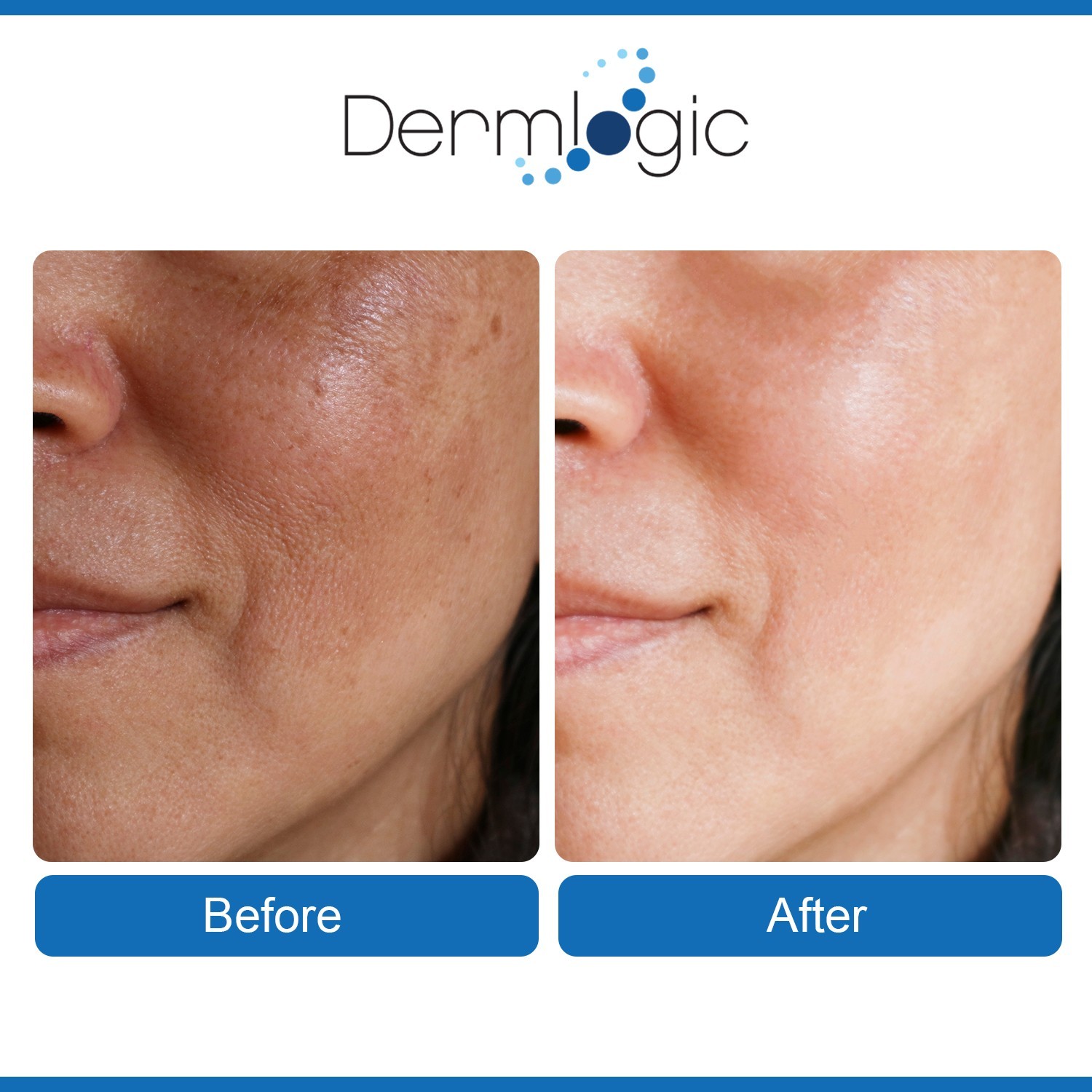 Anti Aging Resurfacing Peel Pads- Triple Action Chemical Peel Pads.