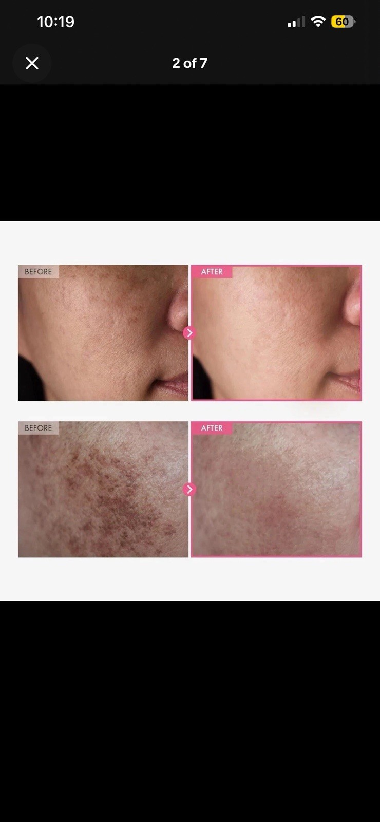 Arbutin 7% + Tranexamic Acid 4% Cream, 70,000Ppm Arbutin, 40,000Ppm TXA, Niacina