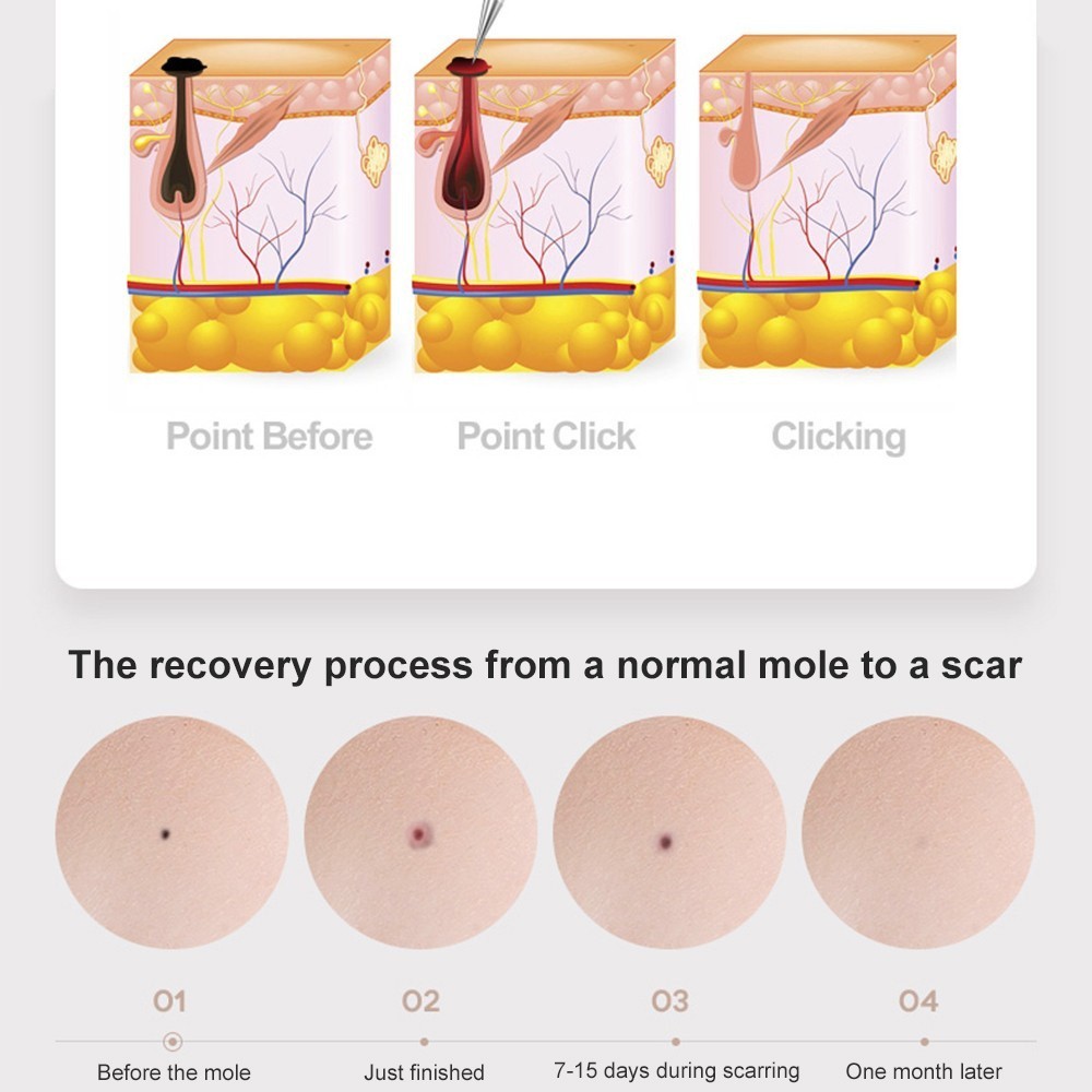 High Quality Wrinkle Removal Plasma Pen Skin Care Anti-Aging Skin Rejuvenation