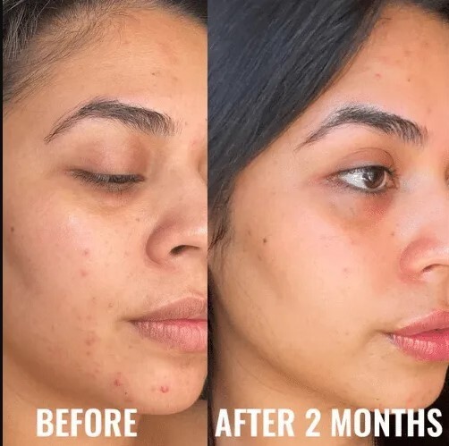 Niacinamide 10% +Zink 1% +Hyaluronic Acid | Acne/Blemish/Oil Control Serum/Cream