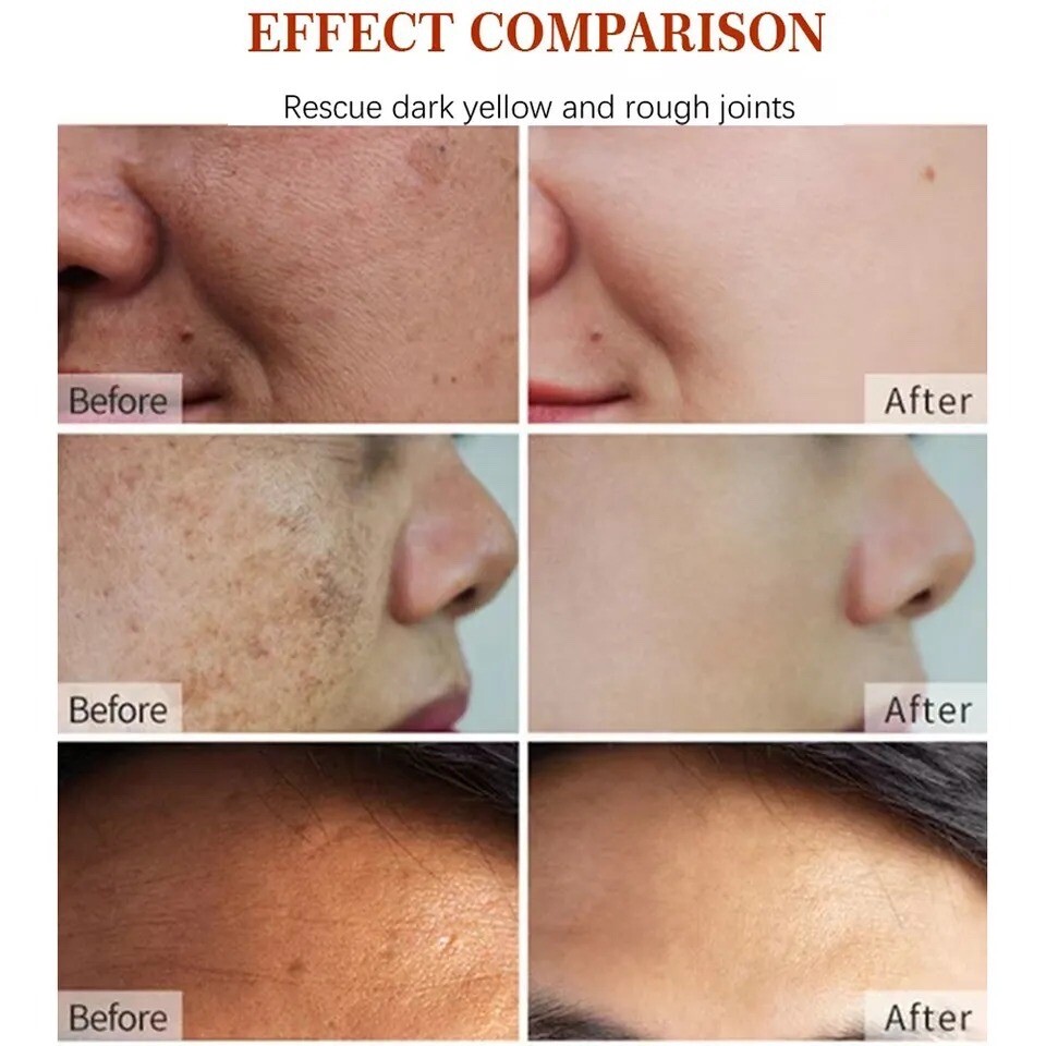 Dark Spot Corrector Face Neck Skin Dark Spot Remover Cream 45% Active Pigment