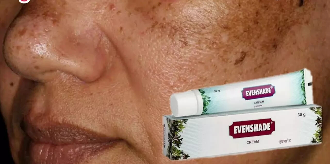 Ayurvedic Melasma Treatment Cream 30gm skin pigmentation like melasma, chloasma