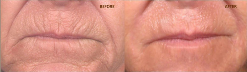UPPER LIP PLUMPER COMPLEX ~LIP PERIORAL FILLER TREATMENT~CHAPPED LIPS NO MORE!