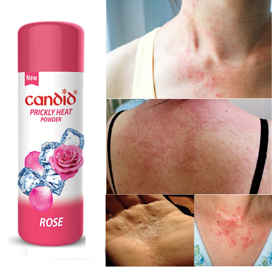 Candid Prickly Heat Powder With Rose | 120 Gm relief from itching and burning