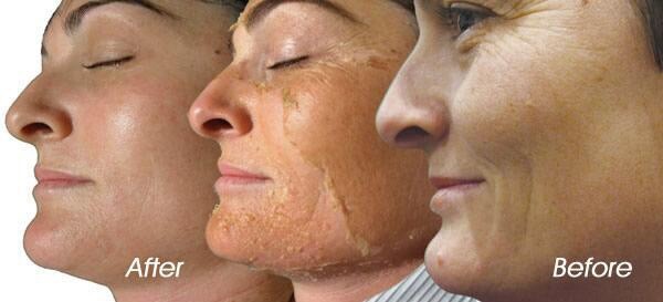 Resurfacing Chemical Peel 90% Acid Concentrated Formula MUST DILUTE Niacinamide