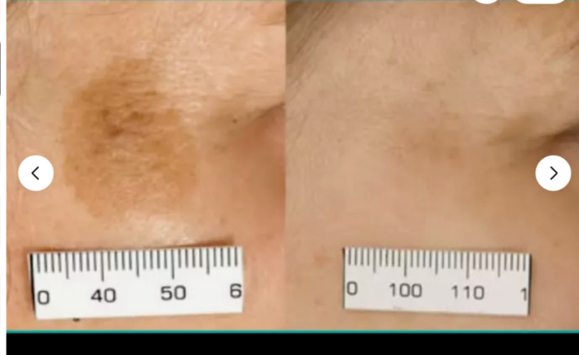 Sun Spot, Age Spot, Brown Spot, Dark Spot Corrector Treatment Remover: No Scam💙