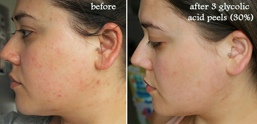 GLYCOLIC ACID CHEMICAL FACE PEEL Kit Medical Grade 100% Pure Acne Scars Wrinkles