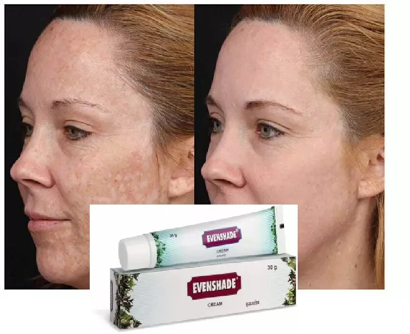 Ayurvedic Melasma Treatment Cream 30gm skin pigmentation like melasma, chloasma