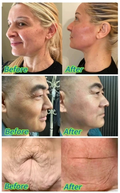 3 in 1 Professional Face Lift Body Slim Skin Firm Skin Rejuvenation Machine
