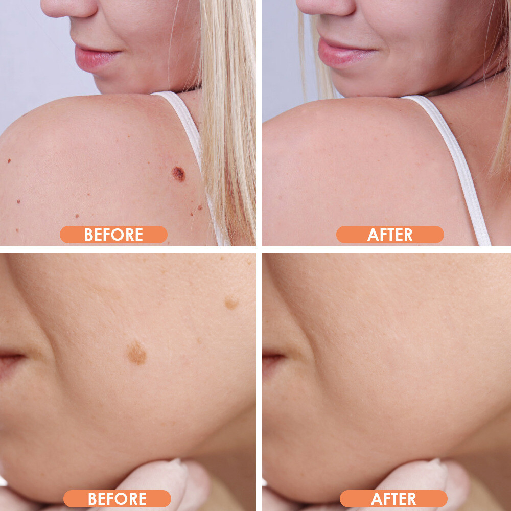 Laser Plasma Pen Mole Removal Dark Spot Skin Tag Tattoo Mole Wart Remover Pen