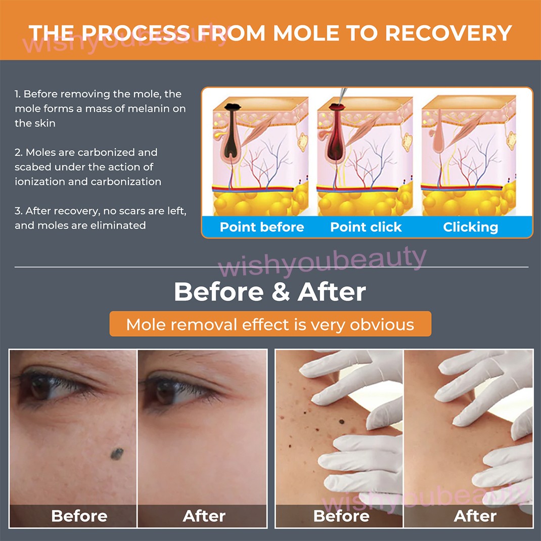 Plasma Pen Physically Skin Tag Mole Remover 15 Levels Laser Spot Removal Machine