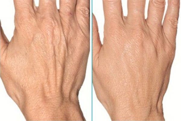 LasmaX-Skin® Anti Aging DARK SPOT CORRECTOR for Face, Body Age Spot Remover