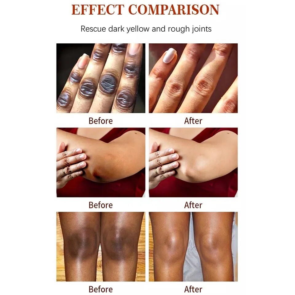 Dark Spot Corrector Face Neck Skin Dark Spot Remover Cream 45% Active Pigment
