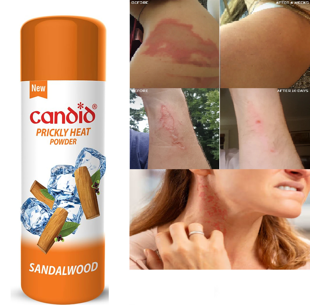 2 X Candid Prickly Heat Powder Cooling Effect On itching With Sandalwood 120gm
